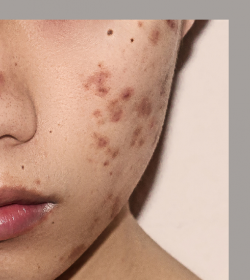 Puistjes zijn populair op Instagram: de opkomst van acne positivity