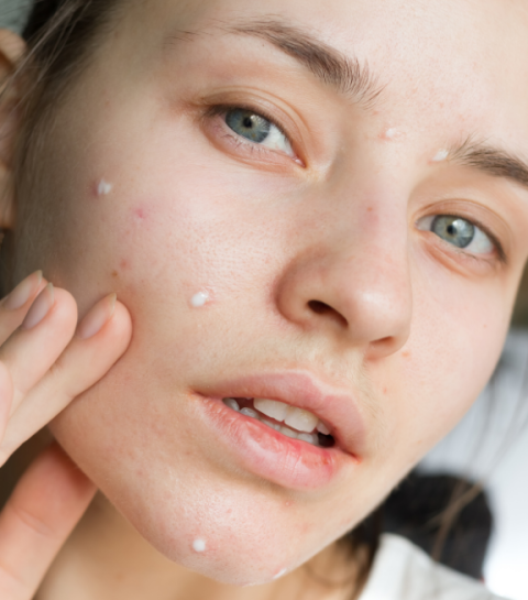 Zo maak je komaf met hormonale acne