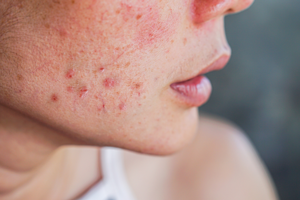 Hormonale acne: dit moet je weten over acne na het stoppen met de pil