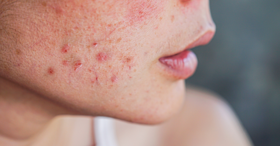 Hormonale acne: dit moet je weten over acne na het stoppen met de pil